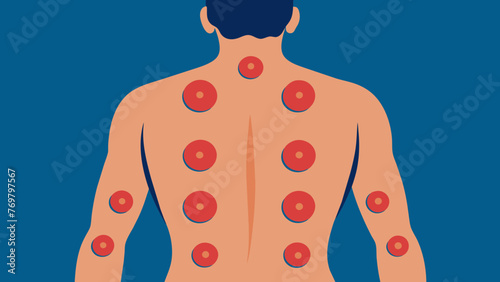  A cropped image of a persons back with multiple cupping marks illustrating the potential widespread pain relief offered through this therapy.