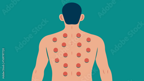  A patients back covered in a gridlike pattern of cupping marks showcasing the effectiveness of this traditional treatment in relieving pain and