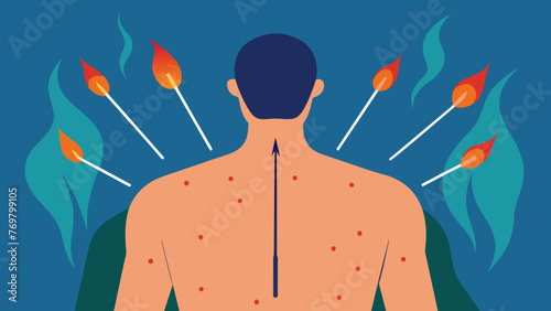  A closeup of a patients back dotted with needles and surrounded by burning incense receiving a treatment for pain and muscle tension.