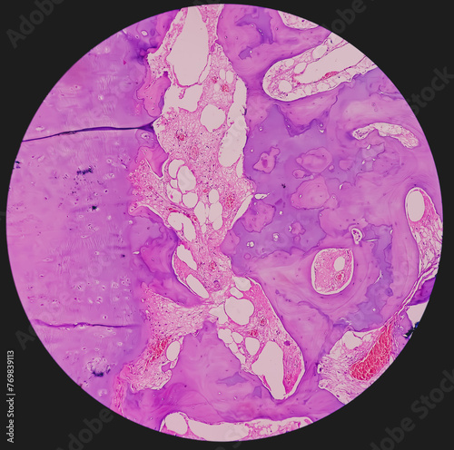 Distal femur (biopsy): Exostosis. Section show mature hyaline cartilage with overlying fibrous perichondrium. photo