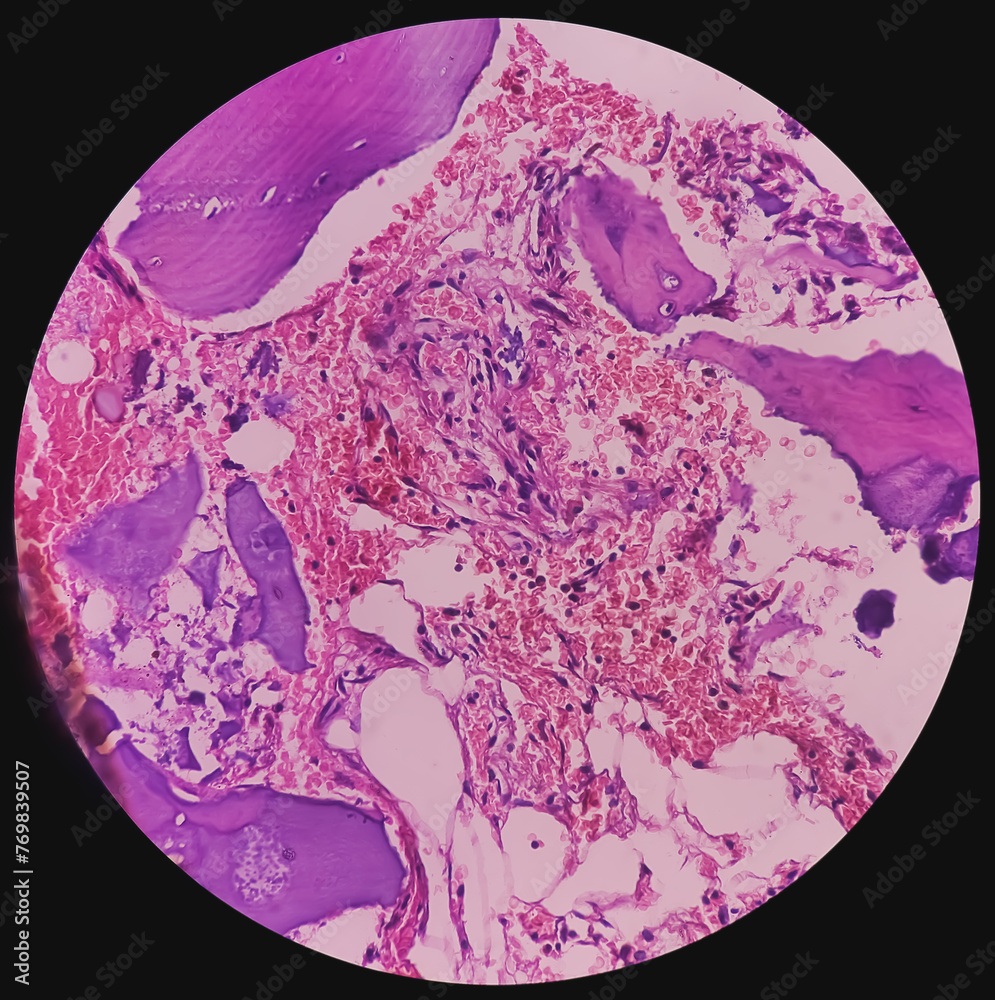 Distal femur (biopsy): Exostosis. Section show mature hyaline cartilage ...