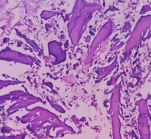 Distal femur (biopsy): Exostosis. Section show mature hyaline cartilage with overlying fibrous perichondrium. photo