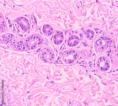 Bild auf Leinwand Hand skin tissue (biopsy) : Prurigo nodularis