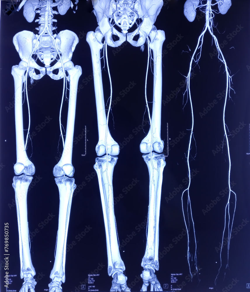 CT angiogram (CTA) shown the abdominal aorta and bine, kidney and ...