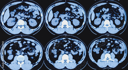 CT scan of KUB (non-contrast): Right lower ureteric calculus (at vesicoureteric junction) causing moderate hydroureteronephrosis of right kidney. Obstructive uropathy.