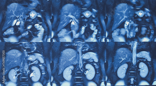 Obraz na płótnie MRCP film of MRI of abdomen