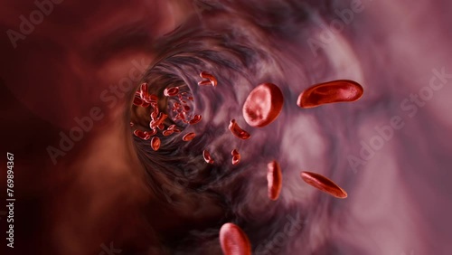 Blood Vessel: Sickle Cell