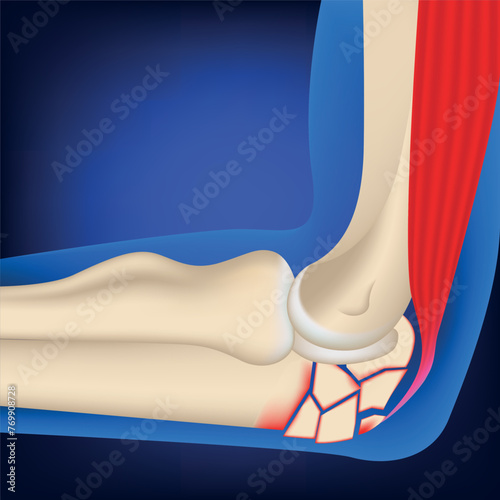 Comminuted fracture of the elbow joint. 3d rendering on a blue background. Medina vector illustration
