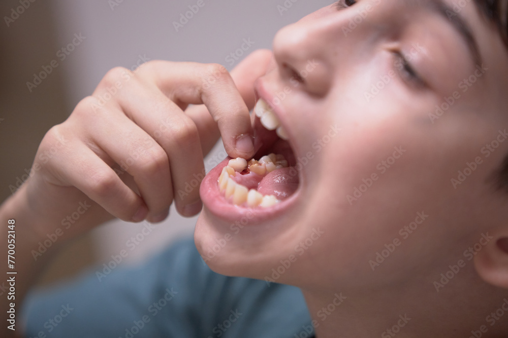 A boy's tooth falls out of his mouth in close-up A boy's tooth falls out of his mouth in close-up