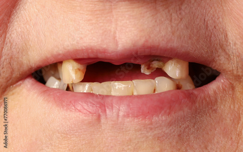 Elderly woman shows toothless mouth, close-up photo