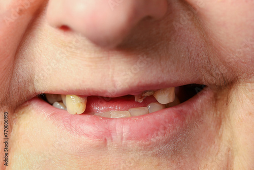 Close-up, toothless mouth of smiling elderly woman photo