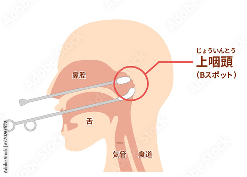 上咽頭擦過治療（Bスポット治療）のやり方と図解 photo