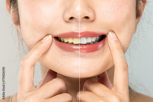 " ホワイトニングの効果 " 黄ばんだ歯と白い歯のクローズアップ相対比較.