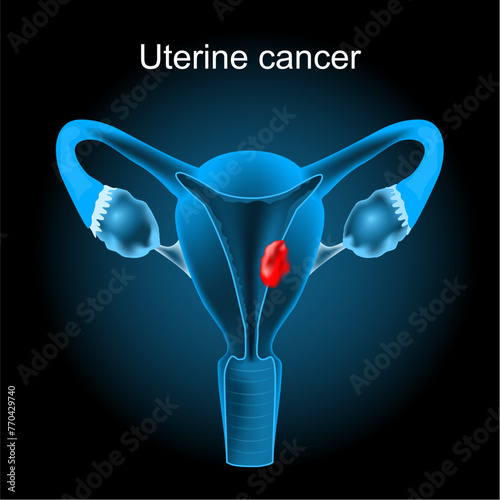 Uterine cancer. Cross section of a human uterus with Endometrial tumor