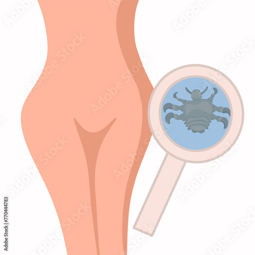 Vector isolated illustration of female pubic lice. Contact with a person with pubic lice.