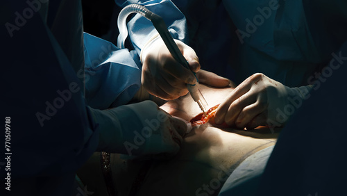 A team of surgeons operates on a young client in a modern operating room. Plastic surgery, close-up, liposuction, health and medicine. photo