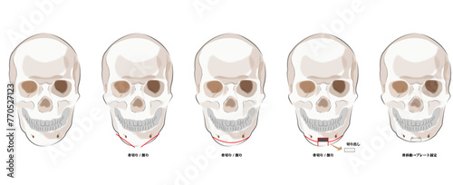 顎削り手術の流れ｜美容整形・輪郭形成の解説図