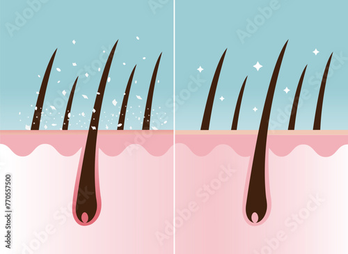 Comparison of dandruff in hair and healthy hair on scalp layer vector illustration. Hair with white dry flaky, scaly scalp and nourished. Hair care and problem concept. photo