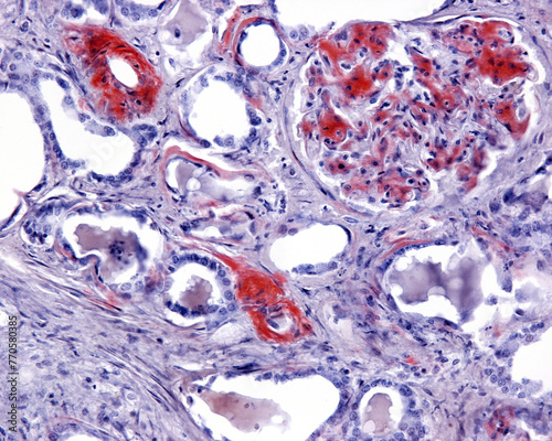 Human kidney. Amyloidosis, Congo red photo