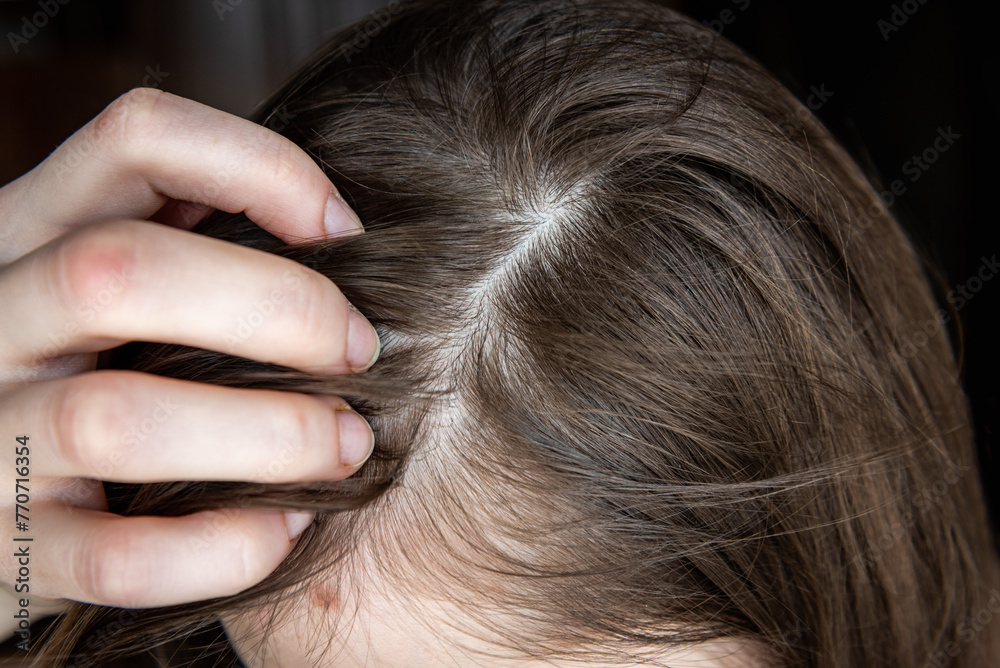 Close up of woman with hair loss problem. Close up of woman with hair loss problem.