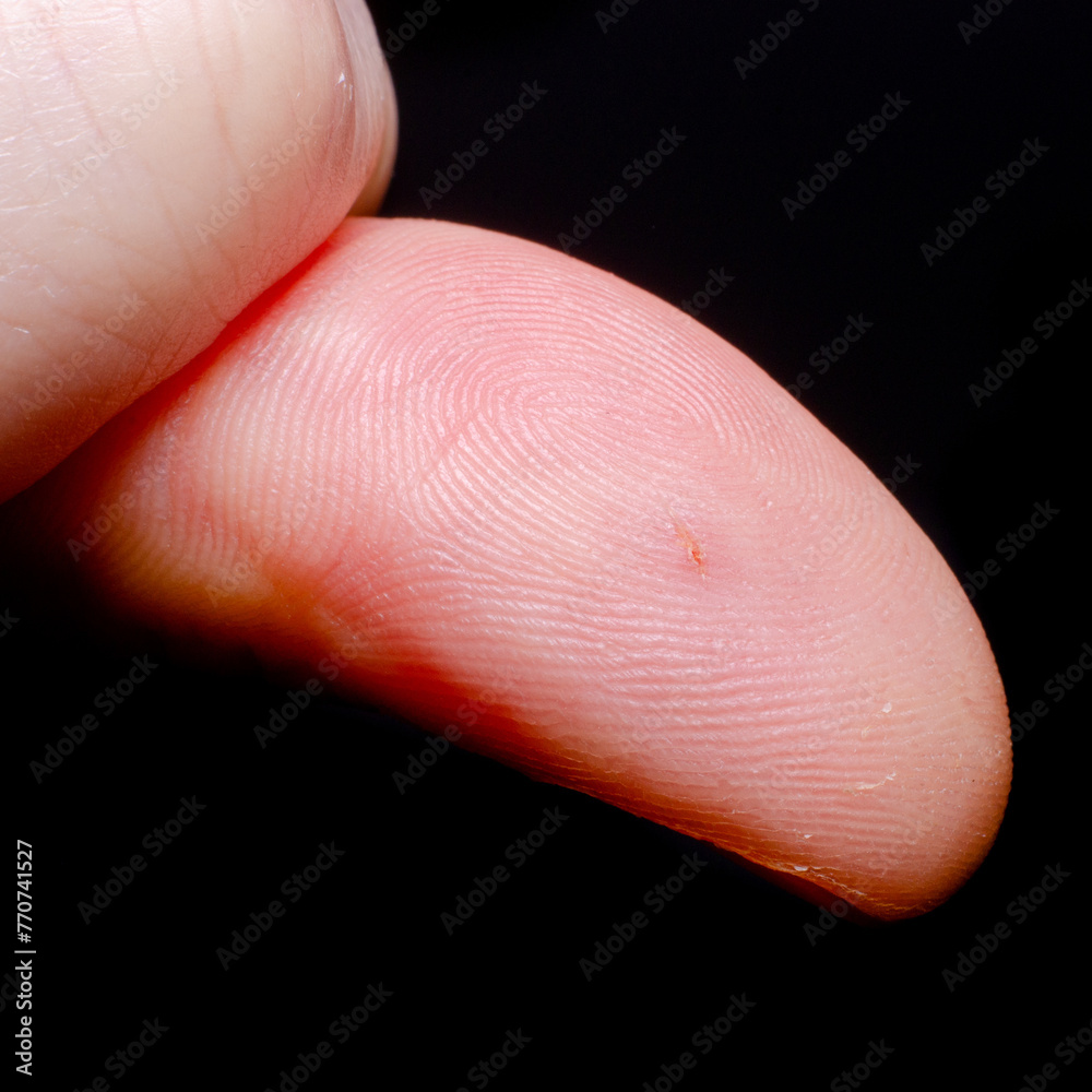 Fototapeta premium Wound on the finger of an adult man on a dark background
