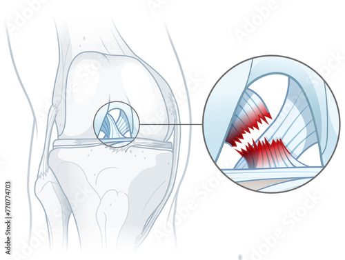Anterior cruciate ligament tear. Knee injury. Medically illustration