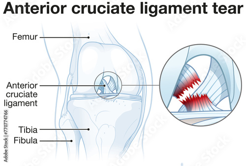 Anterior cruciate ligament tear. Knee injury. Labeled illustration
