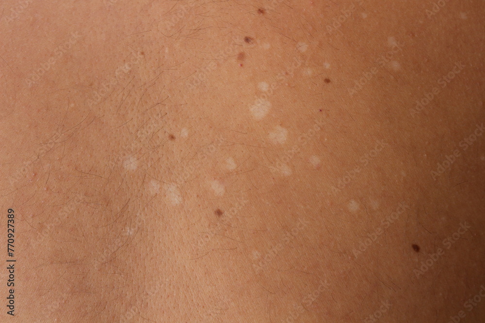 Fototapeta premium Understanding Tinea Versicolor: Managing and Treating Pityriasis Versicolor