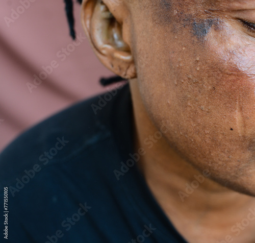 Brown skin woman with dark spots and sun burns with a brown background, hyperpigmentation on brown skin, african american woman with skin blemishes, damaged skin