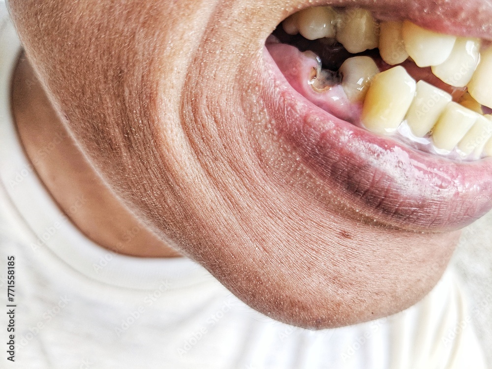 Obraz premium cavities and yellow teeth in humans