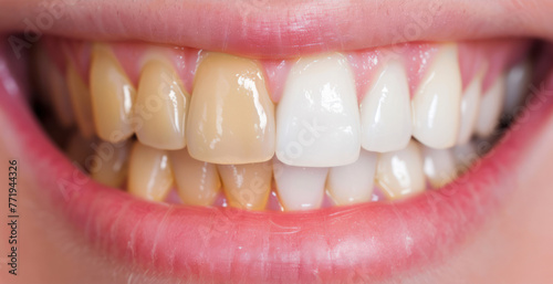 Dramatic Transformation: A Womans Teeth Before and After Dental Treatment photo