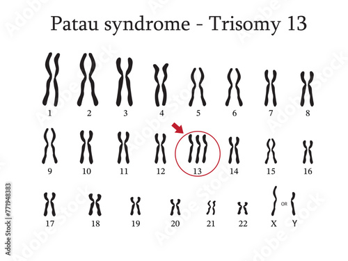 Karyotype of Patau syndrome also known as trisomy 13, is a genetic disorder caused by the presence of all or part of a third copy of chromosome 13.