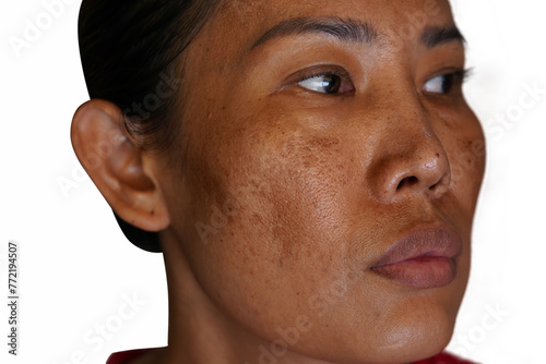 Freckles and Spot melasma pigmentation skin facial treatment over Asian woman face. photo