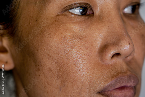 Freckles and Spot melasma pigmentation skin facial treatment over Asian woman face.