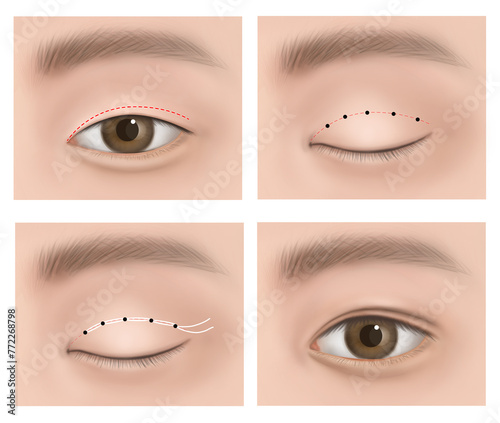 double eyelid operation