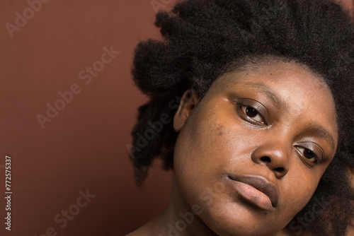 Obraz na plátně Brown skin woman with dark spots, hyperpigmentation on brown skin, african ameri