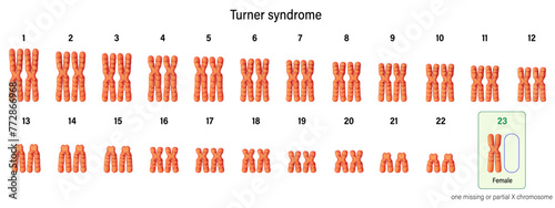Karyotype of Turner syndrome. One of the X chromosomes (sex chromosomes) is missing or partially missing. 45,X, or 45,X0. Genetic disorder that affects females.