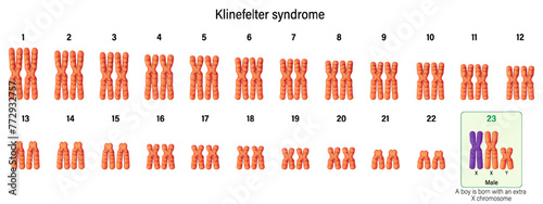 Karyotype of Klinefelter syndrome. Klinefelter's, KS or XXY. A genetic condition that results when a boy is born with an extra copy of the X chromosome.