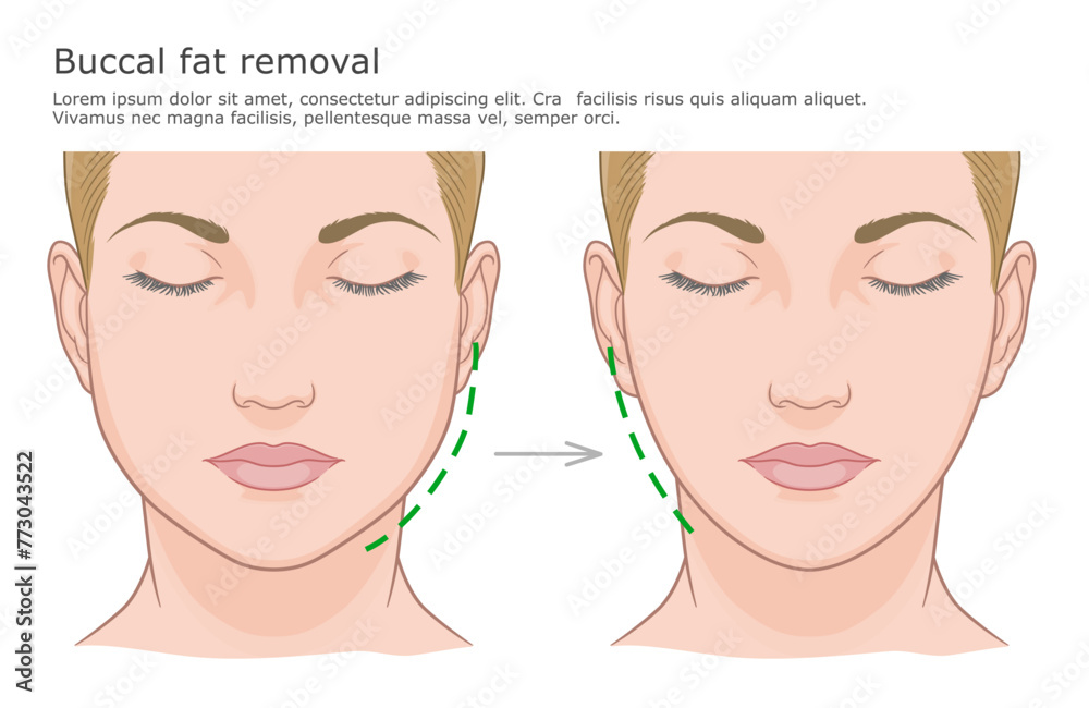 Buccal fat removal surgery illustration. Before and after. Plastic surgery medical illustration. Buccal fat removal surgery illustration. Before and after. Plastic surgery medical illustration.