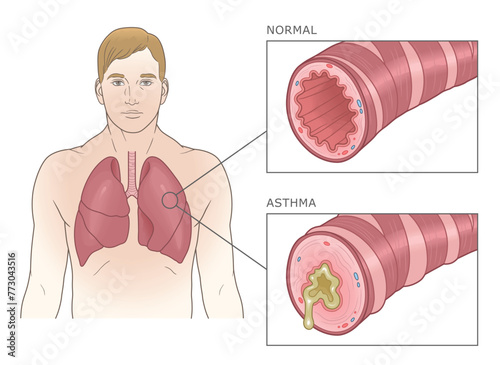 Normal and asthmatic bronchioles with man. Asthma medical vector illustration.