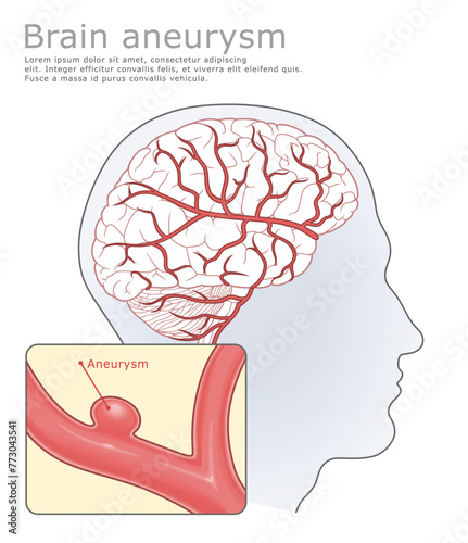 Brain aneurysm and human head with circulatory system medical vector  illustration. photo