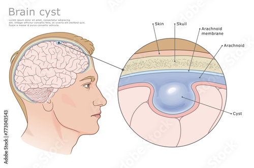 Arachnoid (intracranial) Cyst of the brain labeled medical vector illustration.