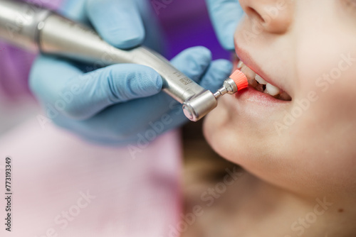 The process of using a dental brush during the stages of a professional teeth cleaning procedure in a clinic.