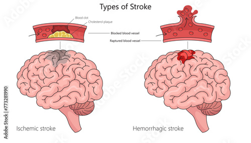 Human ischemic stroke and hemorrhagic stroke in human brain anatomy structure diagram hand drawn schematic vector illustration. Medical science educational illustration photo