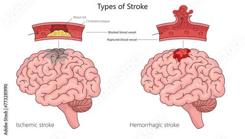 Human ischemic stroke and hemorrhagic stroke in human brain anatomy structure diagram hand drawn schematic vector illustration. Medical science educational illustration