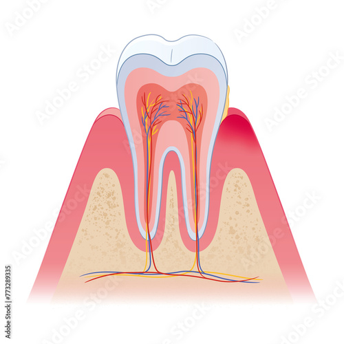 歯周病の歯の断面