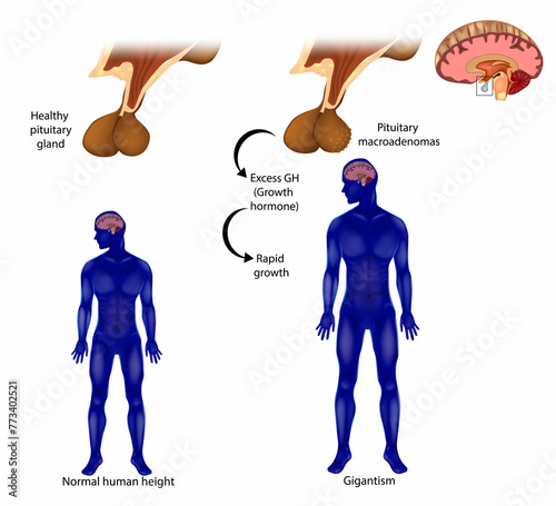 Gigantism  also known as giantism. Adenoma, a tumor of the pituitary gland. Excess GH