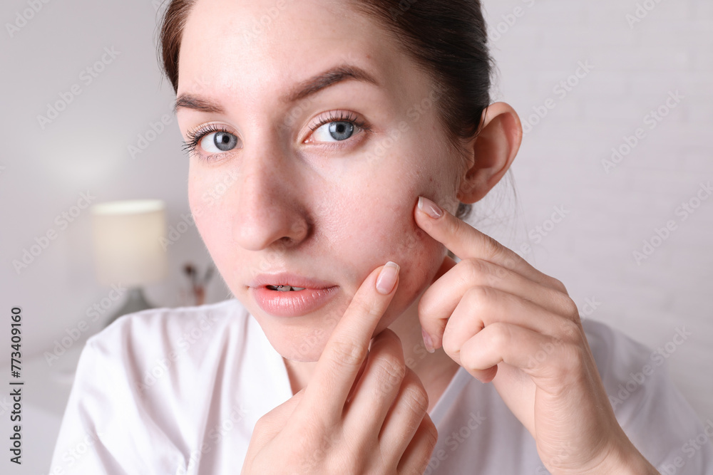 Young woman with acne problem at home Young woman with acne problem at home