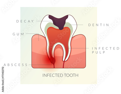 Infected Teeth - Root Canal Treatment - Stock Illustration