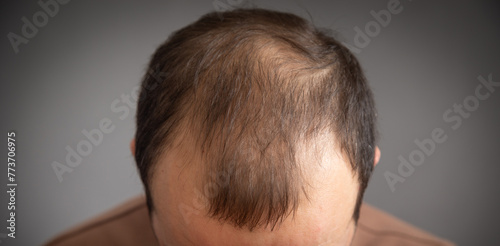 Caucasian man. Hair loss problem © andranik123